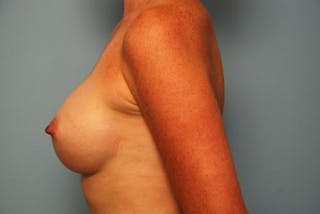 Breast Augmentation Before & After Gallery - Patient 998803 - Image 10