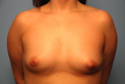 Breast Augmentation Before & After Gallery - Patient 450131 - Image 1