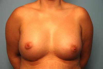 Breast Augmentation Before & After Gallery - Patient 450131 - Image 2