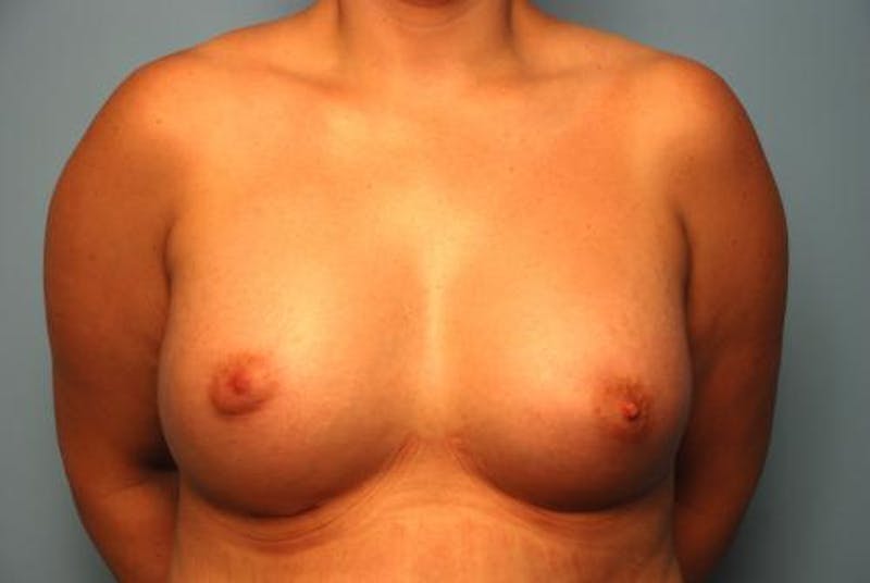 Breast Augmentation Before & After Gallery - Patient 450131 - Image 2