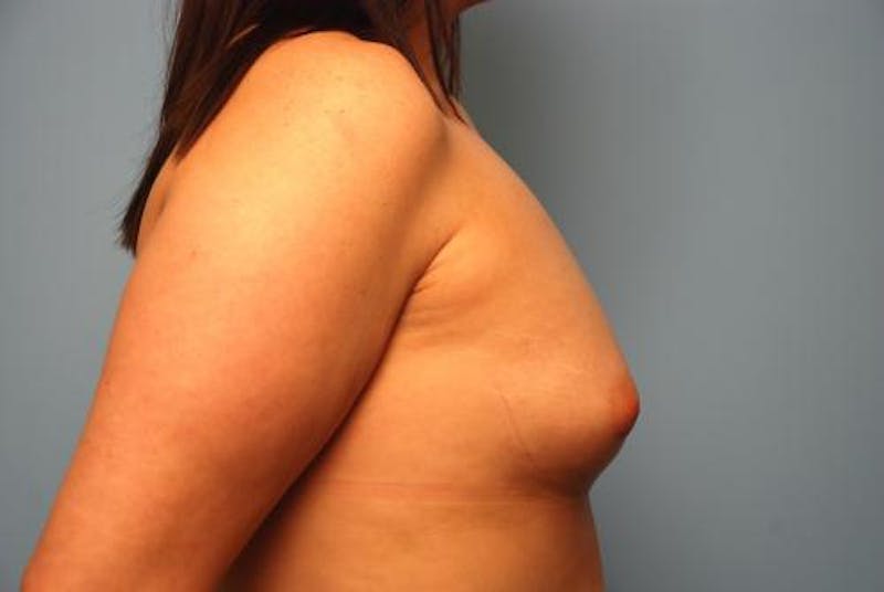 Breast Augmentation Before & After Gallery - Patient 450131 - Image 5