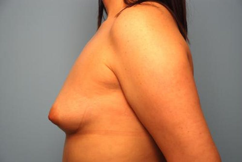 Breast Augmentation Before & After Gallery - Patient 450131 - Image 9