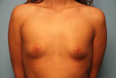 Breast Augmentation Before & After Gallery - Patient 133415 - Image 1