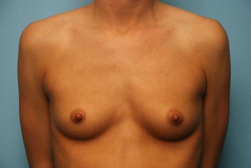 Breast Augmentation Before & After Gallery - Patient 368979 - Image 1