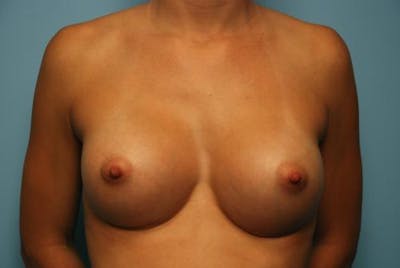 Breast Augmentation Before & After Gallery - Patient 368979 - Image 2