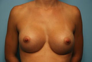 Breast Augmentation Before & After Gallery - Patient 368979 - Image 2