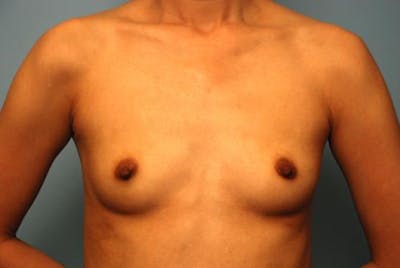 Breast Augmentation Before & After Gallery - Patient 161467 - Image 1