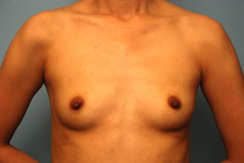 Breast Augmentation Before & After Gallery - Patient 161467 - Image 1