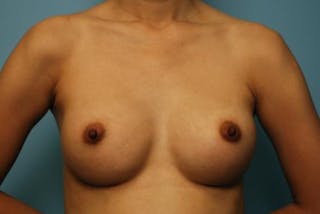 Breast Augmentation Before & After Gallery - Patient 161467 - Image 2