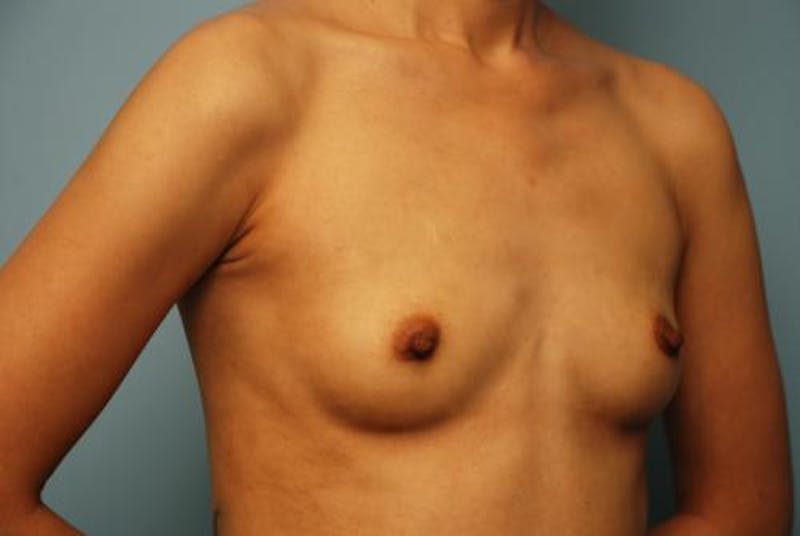 Breast Augmentation Before & After Gallery - Patient 161467 - Image 3