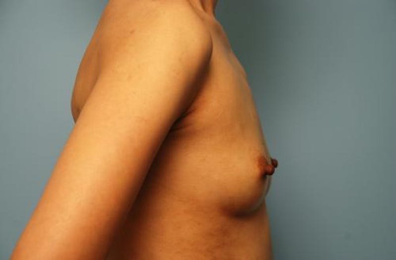 Breast Augmentation Before & After Gallery - Patient 161467 - Image 5