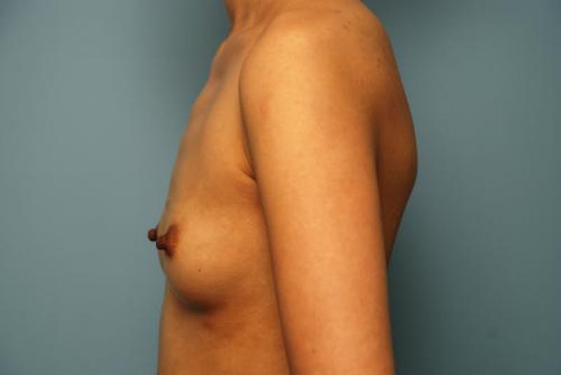 Breast Augmentation Before & After Gallery - Patient 161467 - Image 7