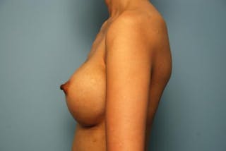 Breast Augmentation Before & After Gallery - Patient 161467 - Image 10
