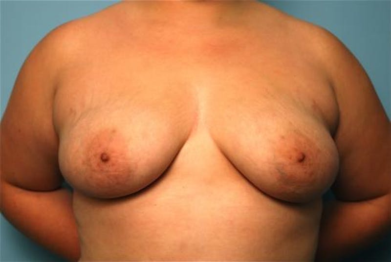 Breast Augmentation Before & After Gallery - Patient 530063 - Image 1