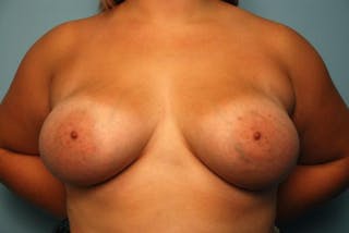 Breast Augmentation Before & After Gallery - Patient 530063 - Image 2