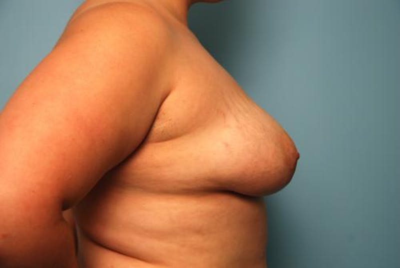 Breast Augmentation Before & After Gallery - Patient 530063 - Image 5