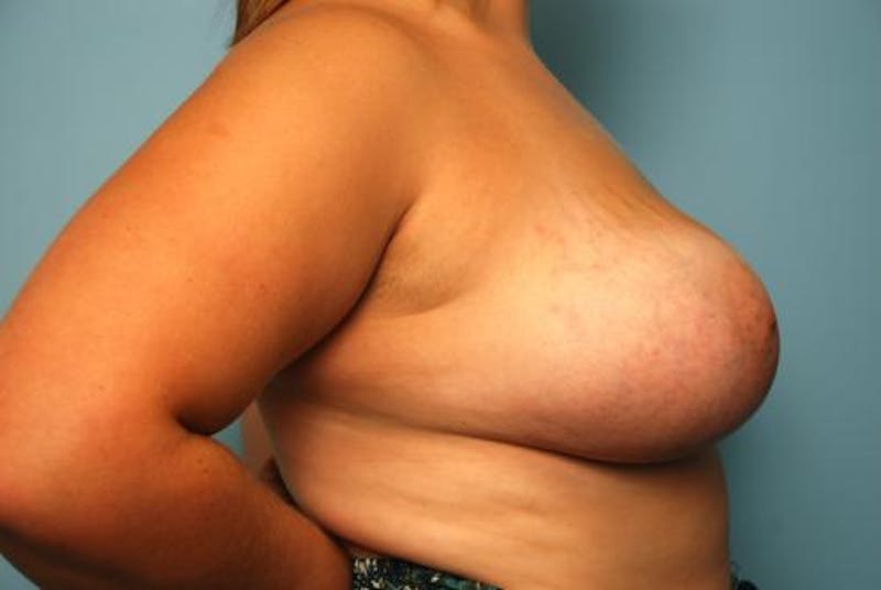 Breast Augmentation Before & After Gallery - Patient 530063 - Image 6