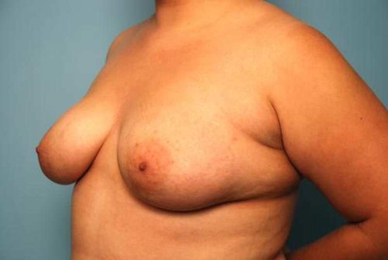 Breast Augmentation Before & After Gallery - Patient 530063 - Image 7