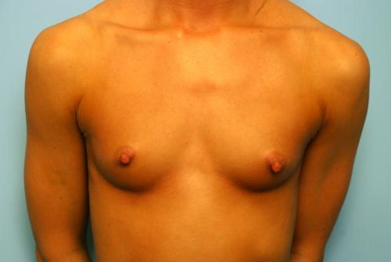 Breast Augmentation Before & After Gallery - Patient 157333 - Image 1