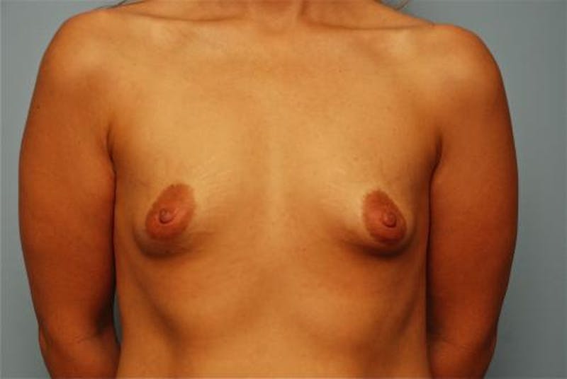 Breast Augmentation Before & After Gallery - Patient 350105 - Image 1