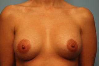 Breast Augmentation Before & After Gallery - Patient 350105 - Image 2