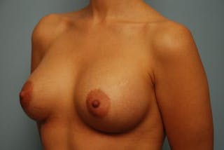 Breast Augmentation Before & After Gallery - Patient 350105 - Image 8