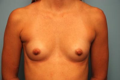 Breast Augmentation Before & After Gallery - Patient 181542 - Image 1