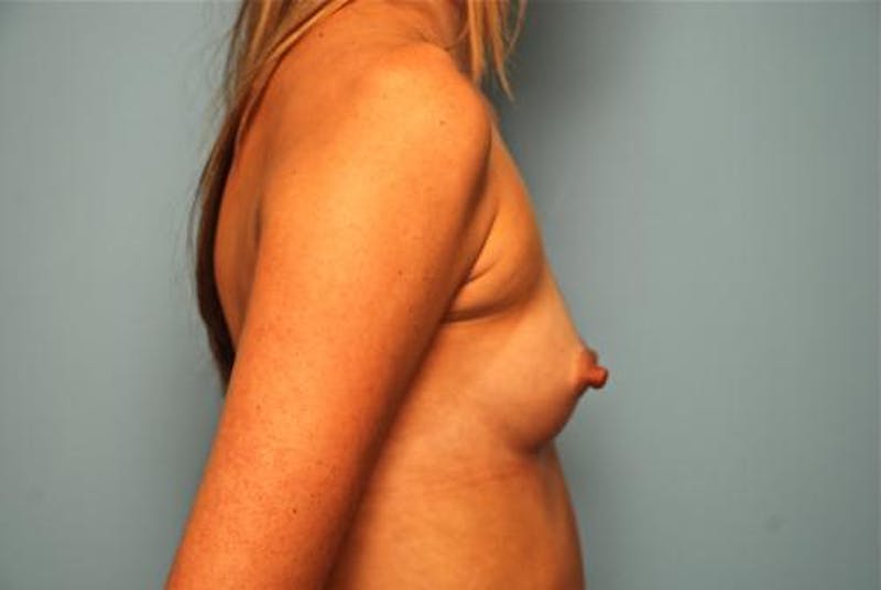 Breast Augmentation Before & After Gallery - Patient 181542 - Image 5