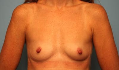Breast Augmentation Before & After Gallery - Patient 284322 - Image 1