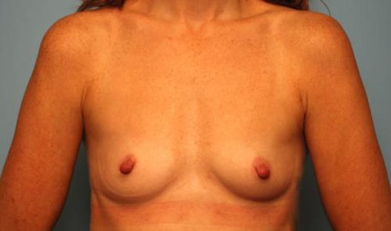 Breast Augmentation Before & After Gallery - Patient 284322 - Image 1