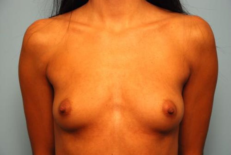 Breast Augmentation Before & After Gallery - Patient 234119 - Image 1