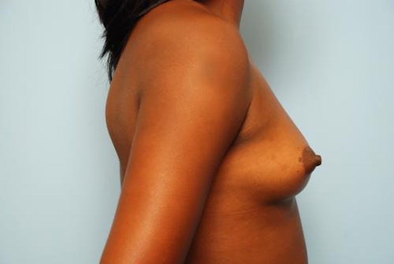 Breast Augmentation Before & After Gallery - Patient 264839 - Image 5