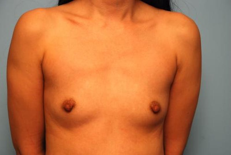 Breast Augmentation Before & After Gallery - Patient 364991 - Image 1