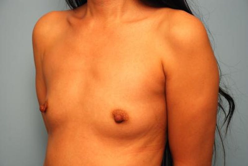 Breast Augmentation Before & After Gallery - Patient 364991 - Image 7