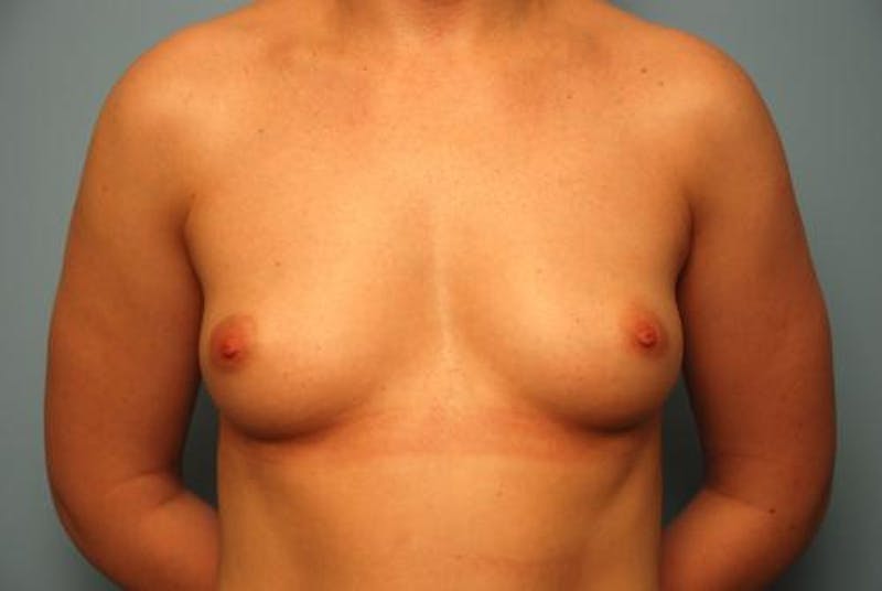 Breast Augmentation Before & After Gallery - Patient 315238 - Image 1