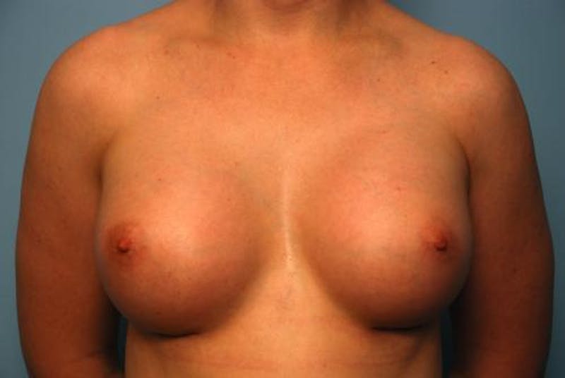 Breast Augmentation Before & After Gallery - Patient 315238 - Image 2
