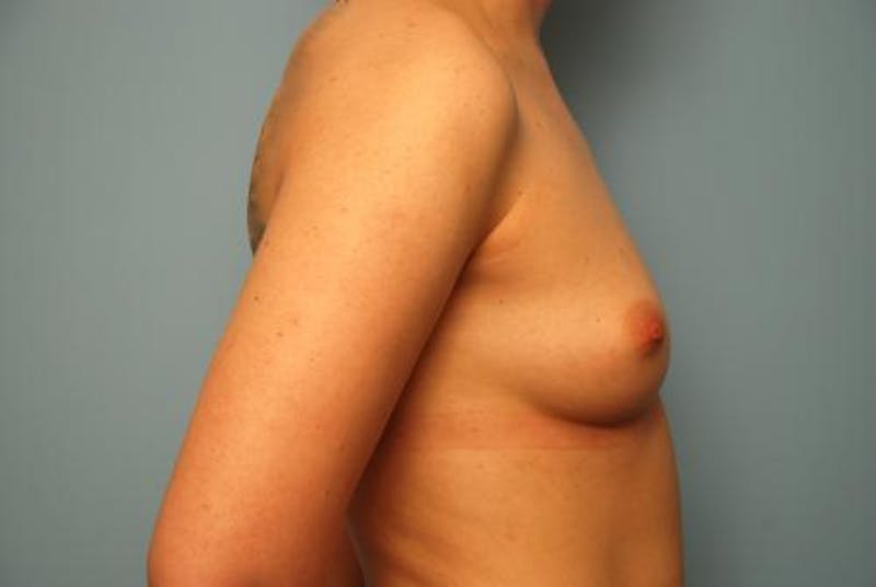 Breast Augmentation Before & After Gallery - Patient 315238 - Image 5