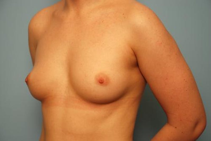 Breast Augmentation Before & After Gallery - Patient 315238 - Image 7