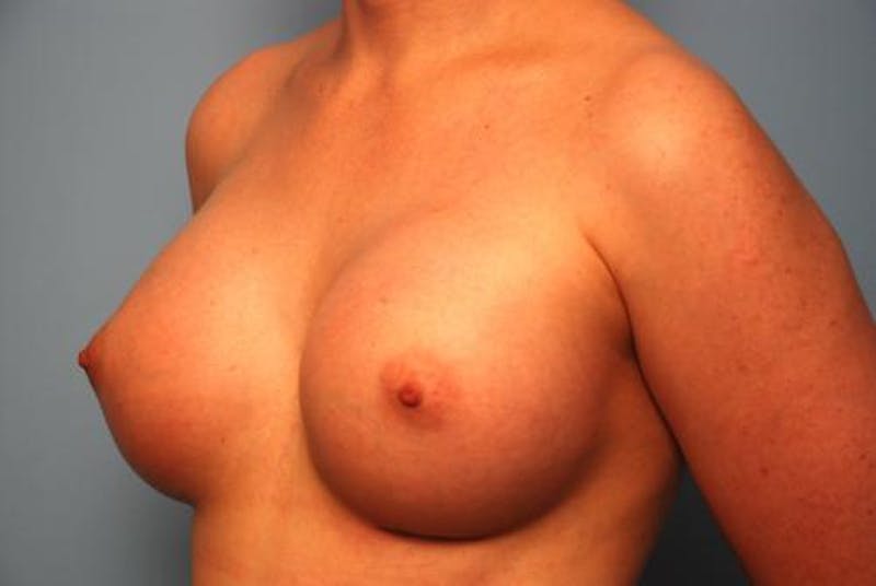 Breast Augmentation Before & After Gallery - Patient 315238 - Image 8