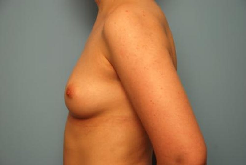 Breast Augmentation Before & After Gallery - Patient 315238 - Image 9