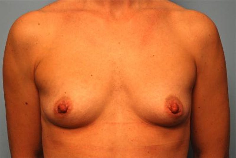 Breast Augmentation Before & After Gallery - Patient 153604 - Image 1