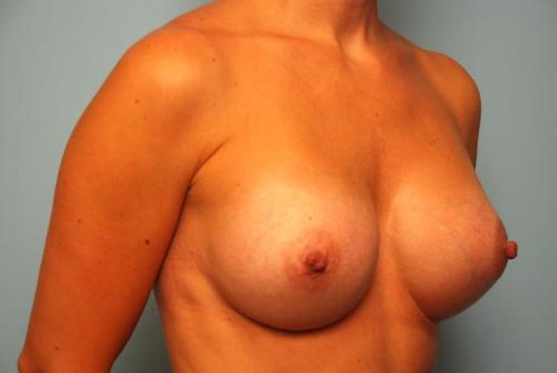 Breast Augmentation Before & After Gallery - Patient 153604 - Image 4
