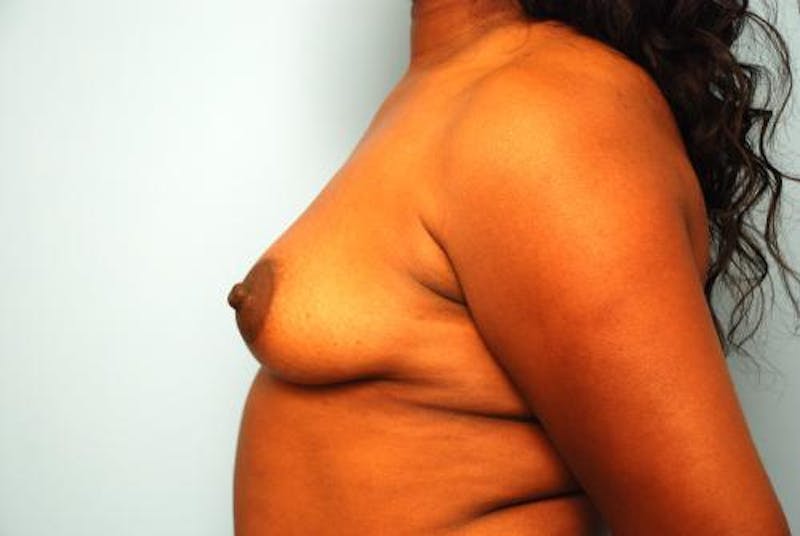 Breast Augmentation Before & After Gallery - Patient 133583 - Image 9