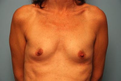 Breast Augmentation Before & After Gallery - Patient 227453 - Image 1