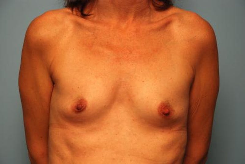 Breast Augmentation Before & After Gallery - Patient 227453 - Image 1