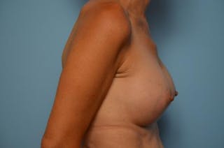 Breast Augmentation Before & After Gallery - Patient 227453 - Image 6