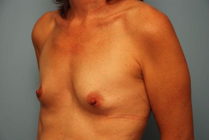 Breast Augmentation Before & After Gallery - Patient 227453 - Image 7