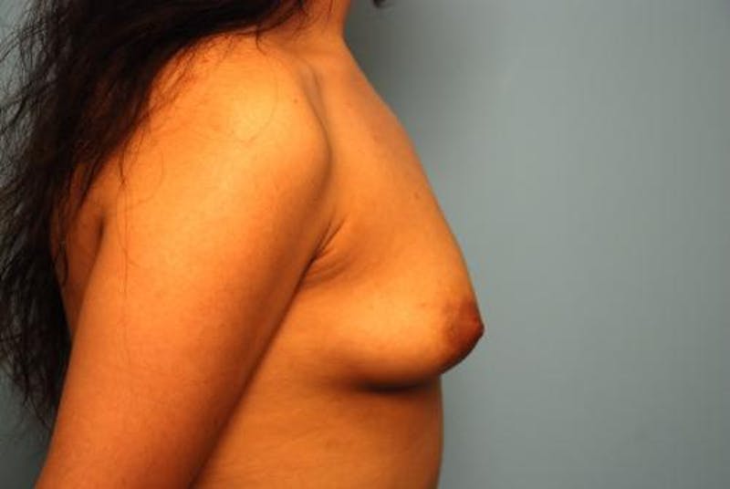Breast Augmentation Before & After Gallery - Patient 342010 - Image 5