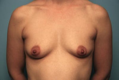 Breast Augmentation Before & After Gallery - Patient 204920 - Image 1