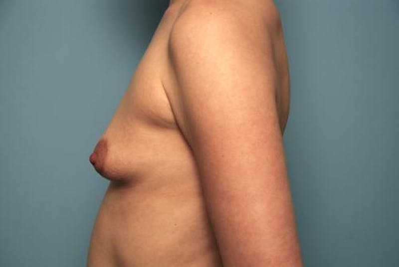 Breast Augmentation Before & After Gallery - Patient 204920 - Image 9